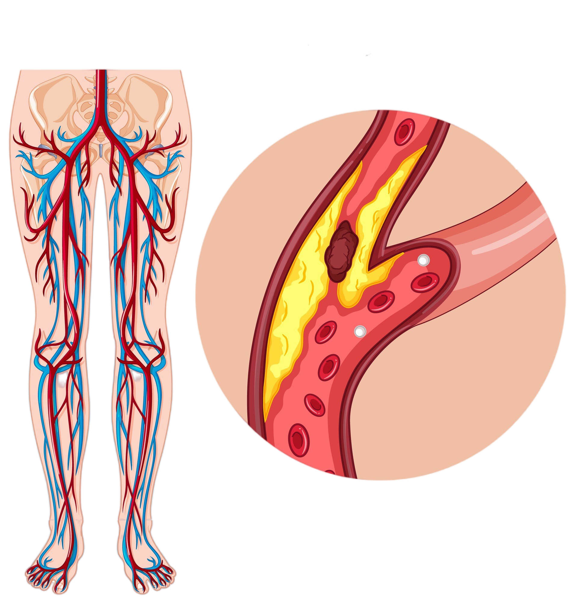 medical-peripheral-artery-disease